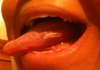 My left side of mouth. I'll have to ask how this happened when I have my follow-up visit.
